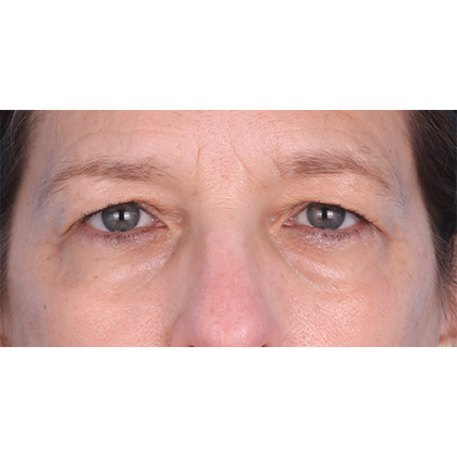 Upper Blepharoplasty Before & After Patient #694