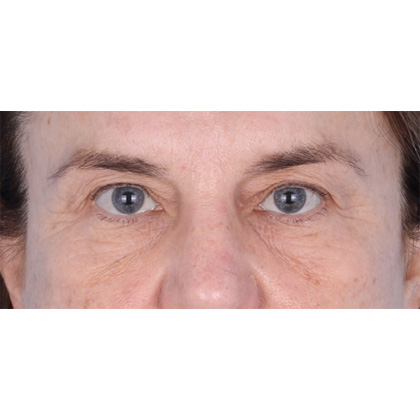 Four Lid Blepharoplasty Before & After Patient #398