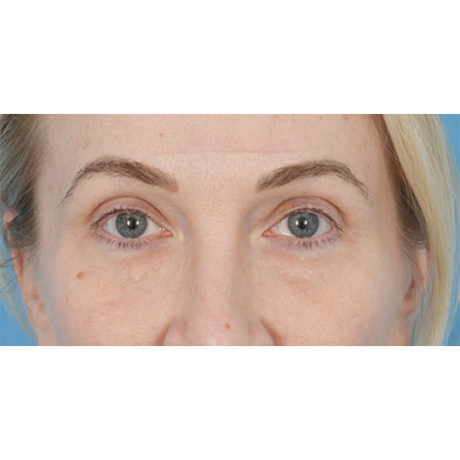 Lower Blepharoplasty Before & After Patient #861