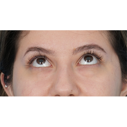 Lower Blepharoplasty Before & After Patient #520