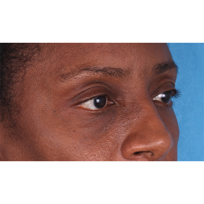 Lower Blepharoplasty Before & After Patient #522
