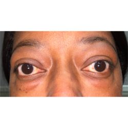 Orbital Decompression Before & After Patient #828