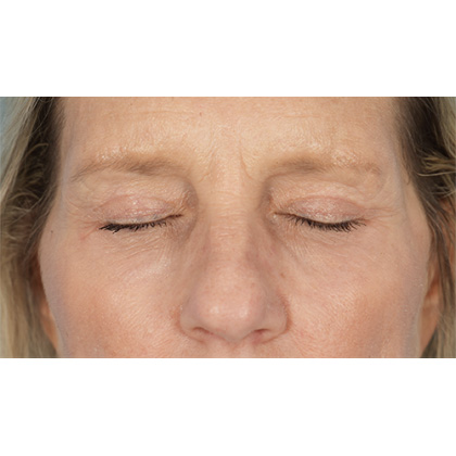 Four Lid Blepharoplasty Before & After Patient #400