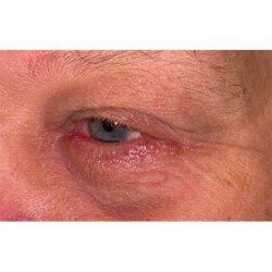 Lesion Removal Before & After Patient #352