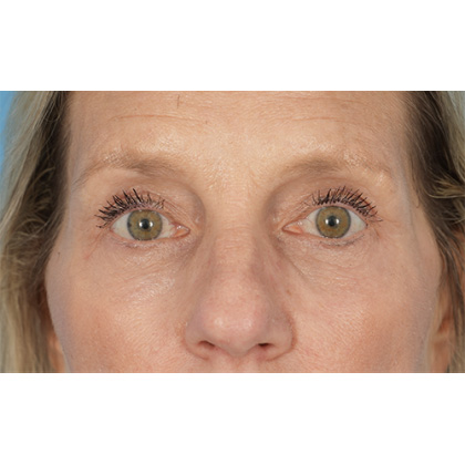 Four Lid Blepharoplasty Before & After Patient #400