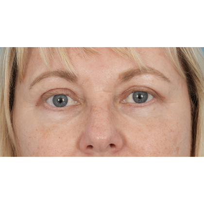 Four Lid Blepharoplasty Before & After Patient #416