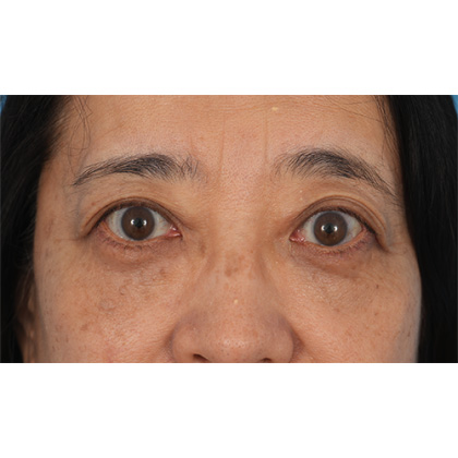 Lower Blepharoplasty Before & After Patient #521