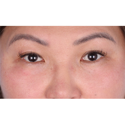 Lower Blepharoplasty Before & After Patient #523