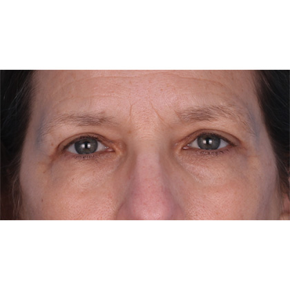Upper Blepharoplasty Before & After Patient #694