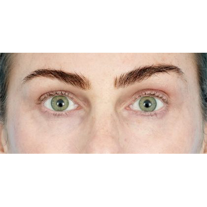 Lower Blepharoplasty Before & After Patient #539