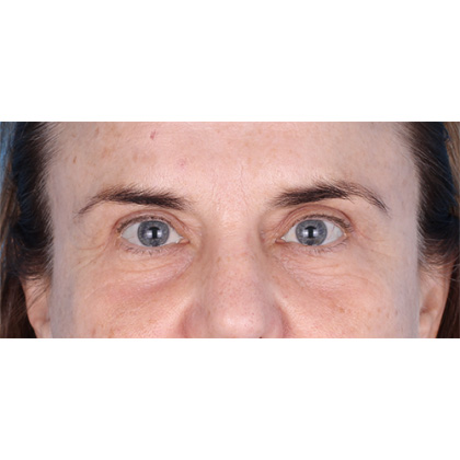 Four Lid Blepharoplasty Before & After Patient #398