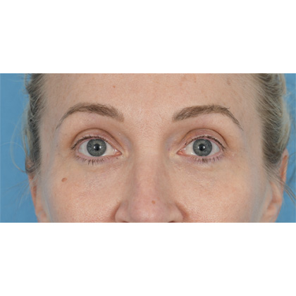 Lower Blepharoplasty Before & After Patient #861