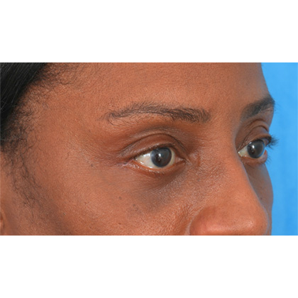 Lower Blepharoplasty Before & After Patient #522