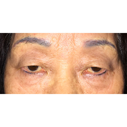 Double Eyelid Surgery Before & After Patient #341
