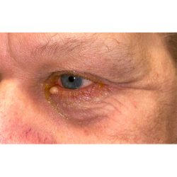 Lesion Removal Before & After Patient #352