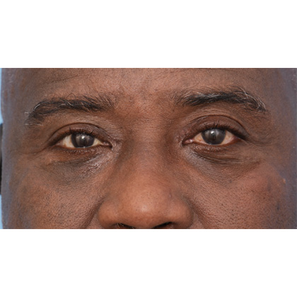Four Lid Blepharoplasty Before & After Patient #395