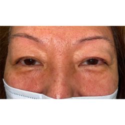 Lesion Removal Before & After Patient #354
