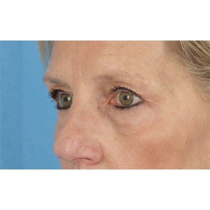 Four Lid Blepharoplasty Before & After Patient #400