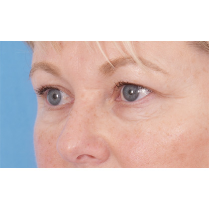 Four Lid Blepharoplasty Before & After Patient #416