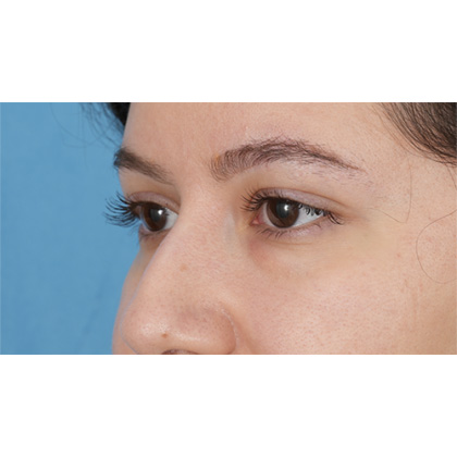 Lower Blepharoplasty Before & After Patient #520