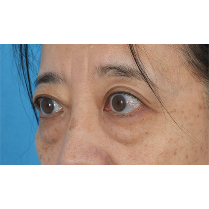 Lower Blepharoplasty Before & After Patient #521