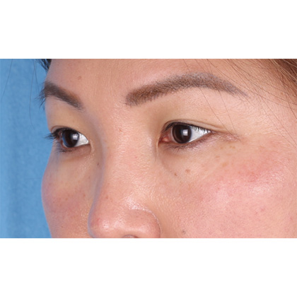 Lower Blepharoplasty Before & After Patient #523