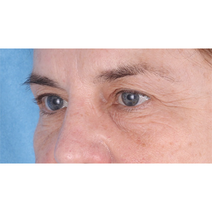 Four Lid Blepharoplasty Before & After Patient #398