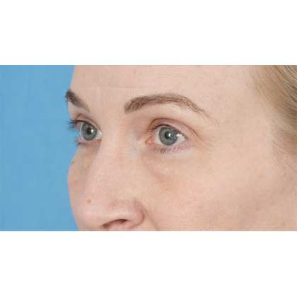 Lower Blepharoplasty Before & After Patient #861
