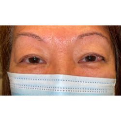 Lesion Removal Before & After Patient #354