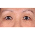 Double Eyelid Surgery Before & After Patient #339