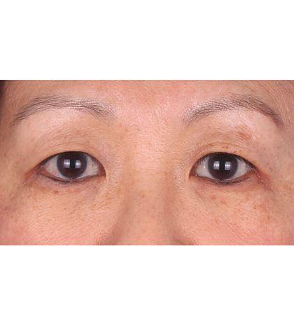 Double Eyelid Surgery Before & After Patient #339