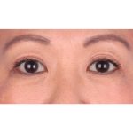 Double Eyelid Surgery Before & After Patient #339