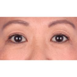 Double Eyelid Surgery Before & After Patient #339