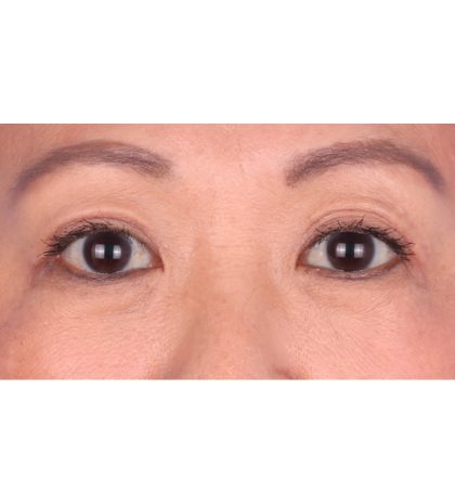 Double Eyelid Surgery Before & After Patient #339