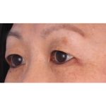 Double Eyelid Surgery Before & After Patient #339