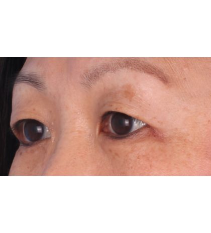 Double Eyelid Surgery Before & After Patient #339