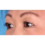 Double Eyelid Surgery Before & After Patient #339