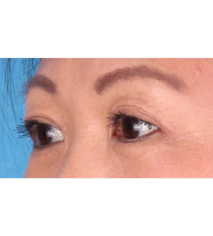 Double Eyelid Surgery Before & After Patient #339