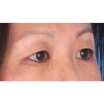 Double Eyelid Surgery Before & After Patient #339