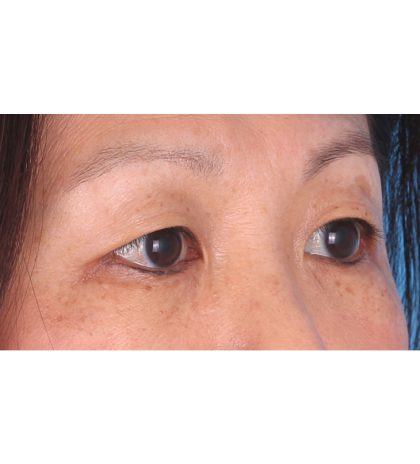 Double Eyelid Surgery Before & After Patient #339