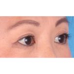 Double Eyelid Surgery Before & After Patient #339