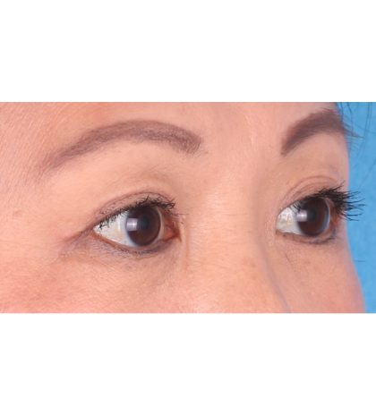 Double Eyelid Surgery Before & After Patient #339