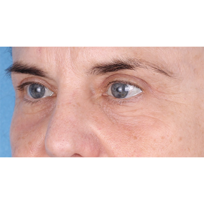 Four Lid Blepharoplasty Before & After Patient #398