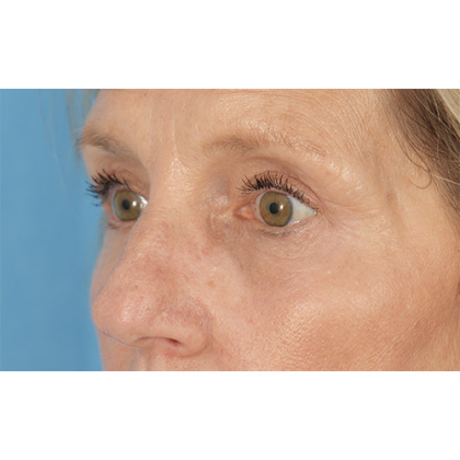 Four Lid Blepharoplasty Before & After Patient #400