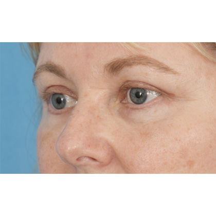 Four Lid Blepharoplasty Before & After Patient #416