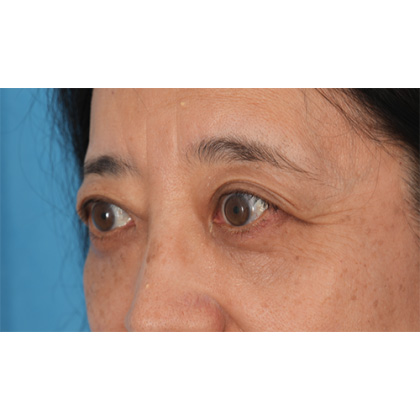 Lower Blepharoplasty Before & After Patient #521