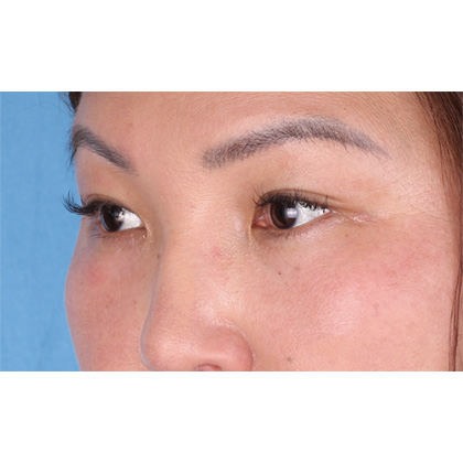 Lower Blepharoplasty Before & After Patient #523