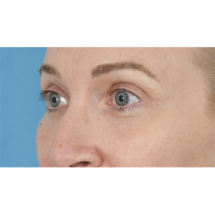 Lower Blepharoplasty Before & After Patient #861