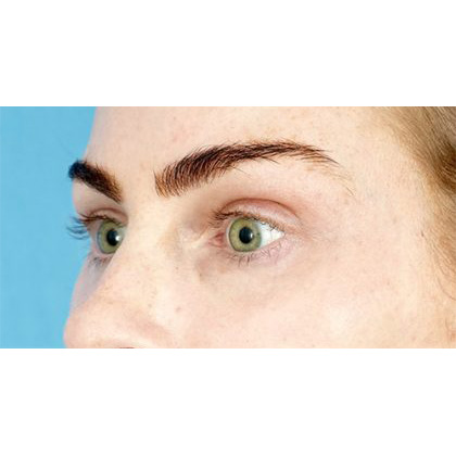 Lower Blepharoplasty Before & After Patient #539