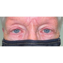Lesion Removal Before & After Patient #355